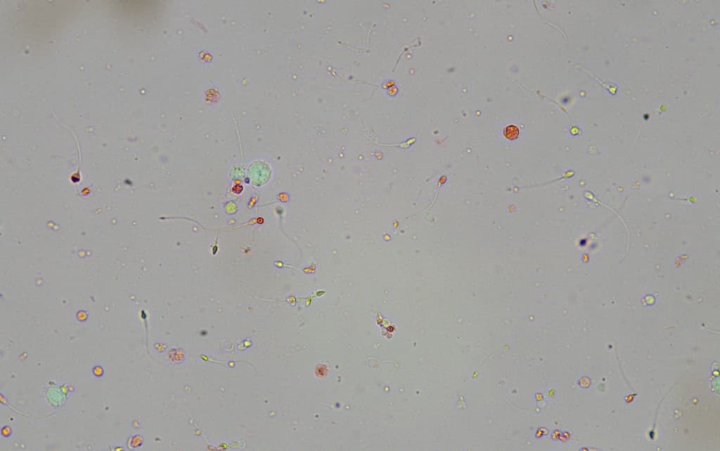 Nativpräparat mit Spermien und Rundzellen